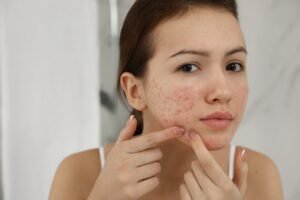 Acne (a.k.a. Pimples or Zits)