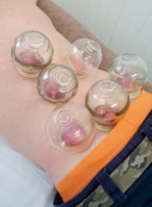 Why do we sometimes use Cupping Therapy in our treatments?